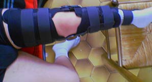 Ma belle attelle&nbsp;! :o)